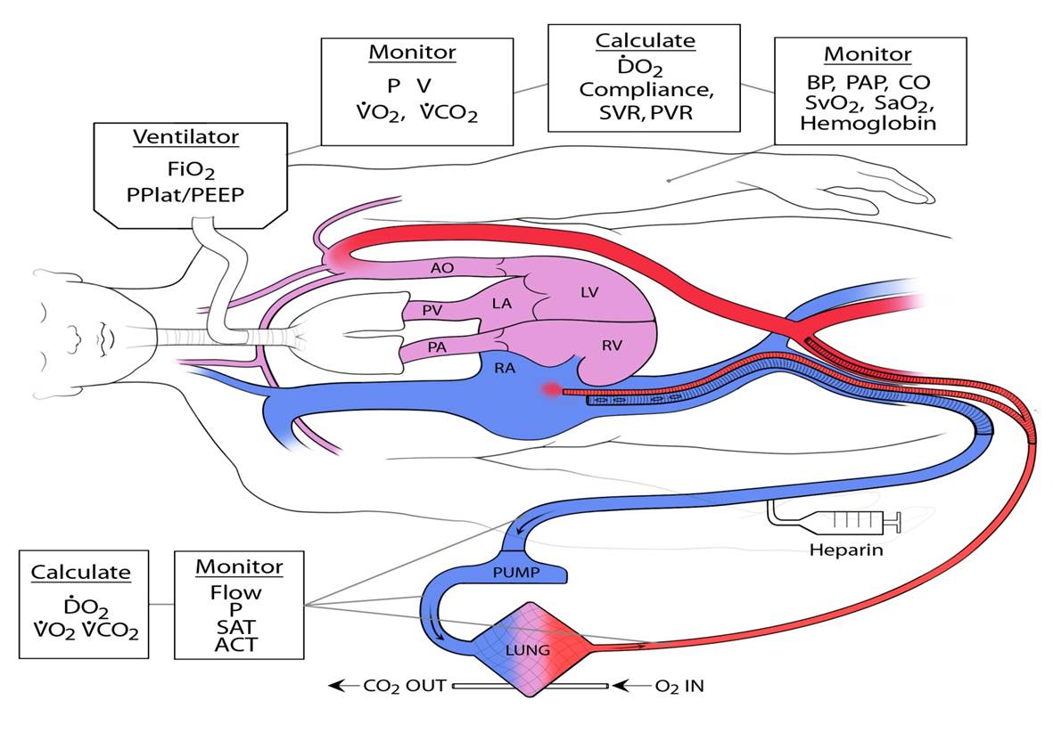 The schematics of the extracorporeal membrane oxygenation, or ECMO, technology, shows the features of the medical device and depicts the process it performs in taking blood from the body, removing carbon dioxide waste and returning healthy blood to patients. Permission for use granted by Thomas V. Brogan, M.D., Senior Editor of Extracorporeal Life Support: The ELSO Red Book 5th Edition, 2017